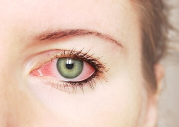 «Синдром» красных глаз - в чем причина?